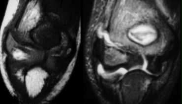 MR of  lateral condyle fracture. Milch II and unstable elbow. T2  image with fat saturation on the right shows cartilaginous fracture.  Fracture-fragment surrounded by synovial fluid. (Courtesy of  Lynne Steinbach, M.D. Univ. of California, San Francisco)